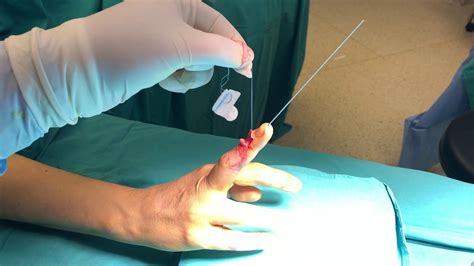 Pull Out Test After Mallet Finger Surgery Youtube