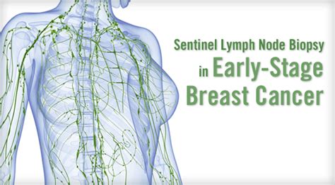 Sentinel Lymph Node Biopsy In Early Stage Breast Cancer Physicians