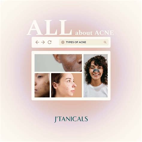 jtanicals uk  instagram acne acne acne remember   teens suffer  acne