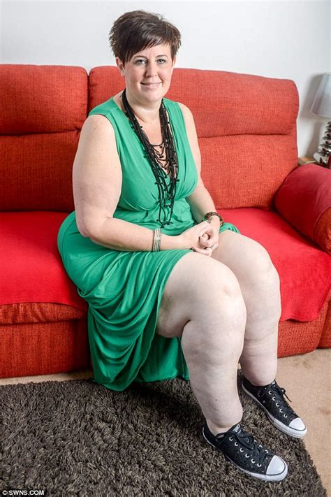 obese mother is left with tree trunk legs due to rare