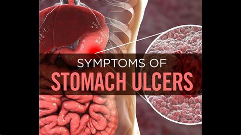 Stomach Ulcers Symptoms Causes And Diagnosis Youtube