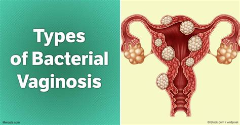 what are the types of bacterial vaginosis