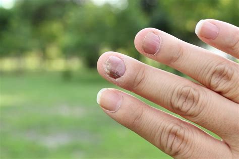 natural remedies  psoriasis   nails