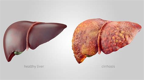 What Is Cirrhosis Everyday Health
