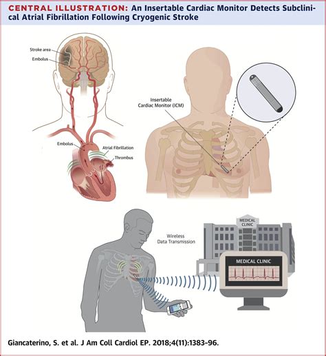 current  future   insertable cardiac monitors jacc clinical