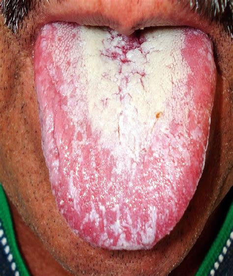 Candidiasis Of The Mouth Hairy Pussy Gals