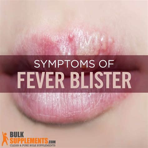 fever blisters causes symptoms and treatments