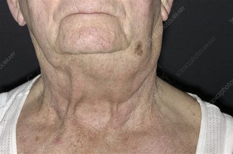 enlarged lymph nodes geekshety