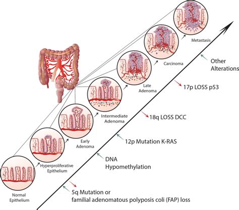 A Genetic Model For Colorectal Tumorigenesis Adapted From Fearon And