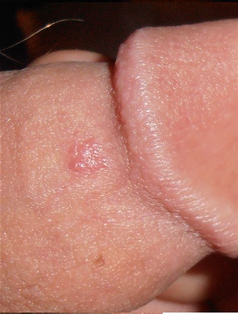 friction blisters penis effects masturbation