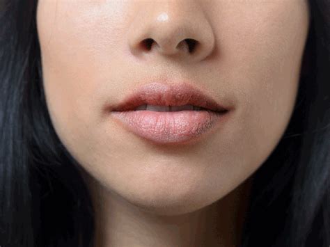 Perioral Dermatitis What To Know About This Annoying Red