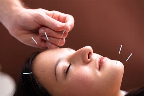 Acupuncture For Migraine Headaches Alleviant Health Centers
