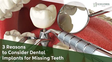 Ppt 3 Reasons To Consider Dental Implants For Missing Teeth