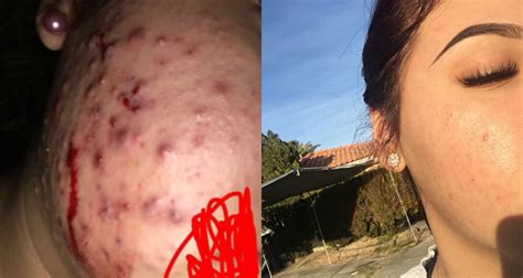 This Woman’s Natural Cure For Cystic Acne Is Going Viral
