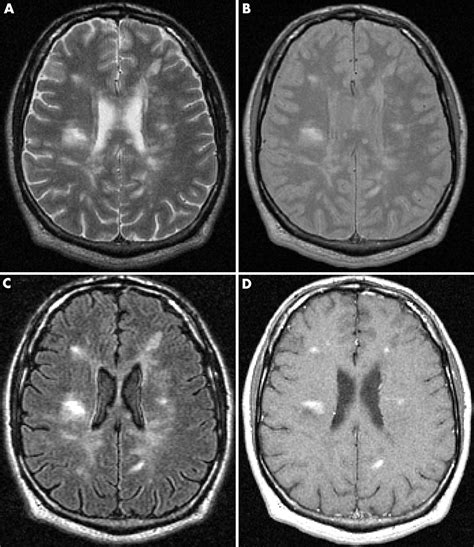 imaging  multiple sclerosis journal  neurology neurosurgery