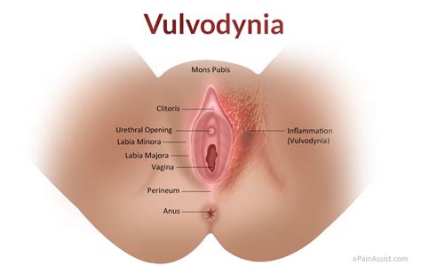 vulvodynia classification types etiology risk factors signs symptoms
