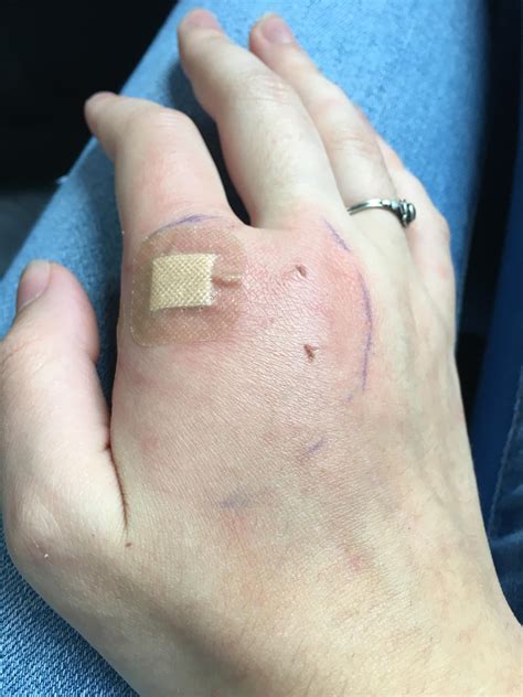 cat bite swollen hand