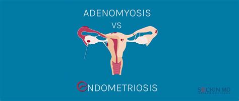 Endometriosis Vs Adenomyosis Seckin Endometriosis Center