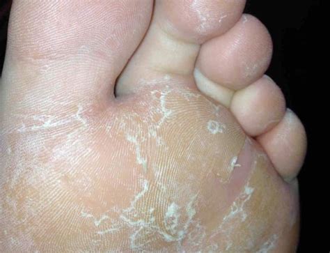 chilblains davenport house clinic