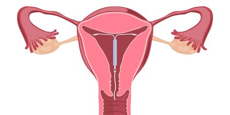 the coil iud pros cons and potential side effects