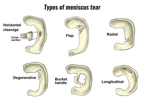 meniscus tear huang orthopaedics