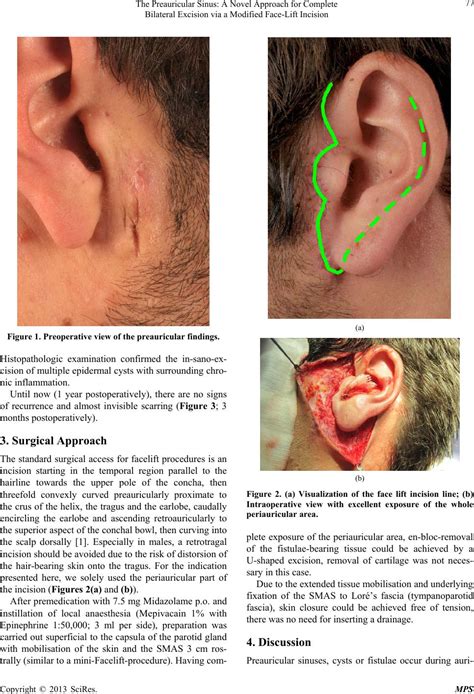 preauricular sinus   approach  complete bilateral excision   modified face