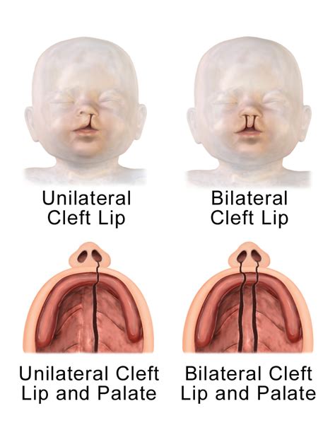fileunilateral  bilateral cleft lip  palatepng wikimedia commons