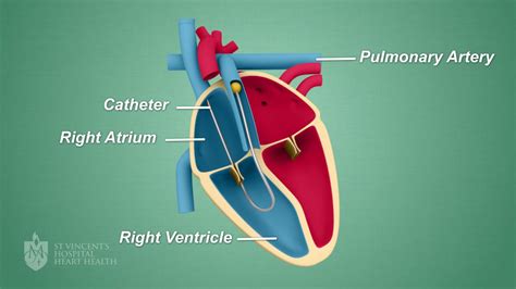 heart catheter st vincents heart health