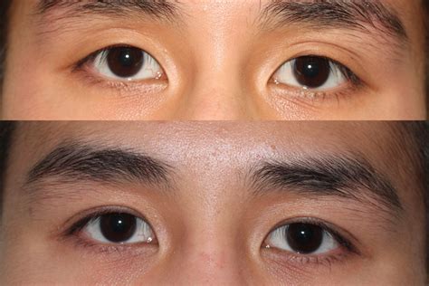 double eyelid surgery asian eyelid result  double eyelid surgery