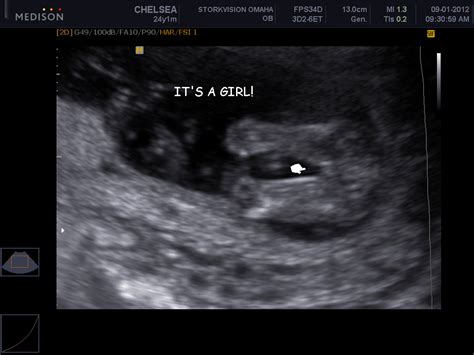 Accuracy of fetal sex