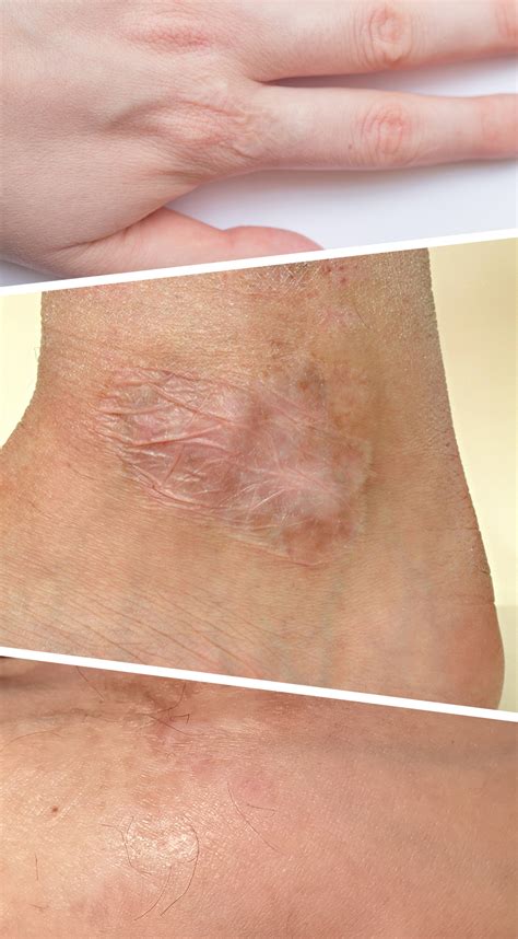 revive  skin laser therapy  burn scars  wisconsin