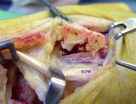 midterm outcome of bone ligament bone graft and dorsal capsulodesis for