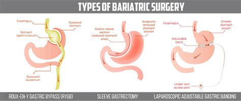 bariatric surgery short term  long term outcomes