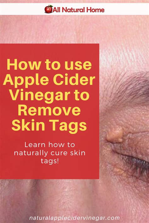 how to use apple cider vinegar to remove skin tags in 2020 with images