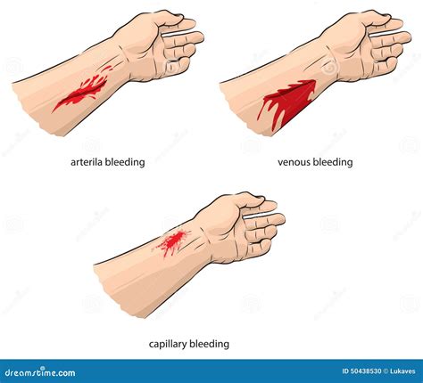 bleeding stock vector illustration  types venous
