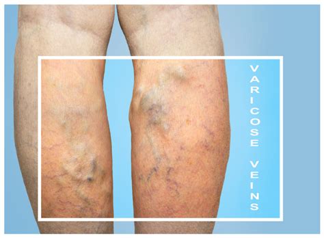 varicose veins dangerous     treat varicose veins
