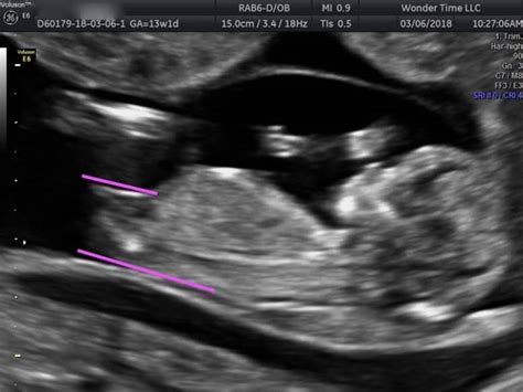 gender ultrasound wondertime llc