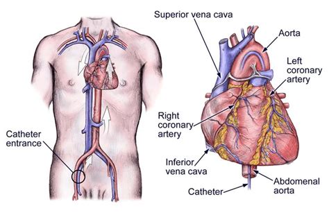 image detail for cardiac catheterization left heart cardiac