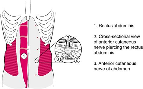abdominal cutaneous nerve entrapment syndrome acnes a