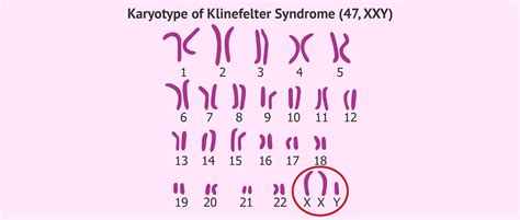 Karyotype Klinefelter Syndrome Pictures Discountedreboundingdvd