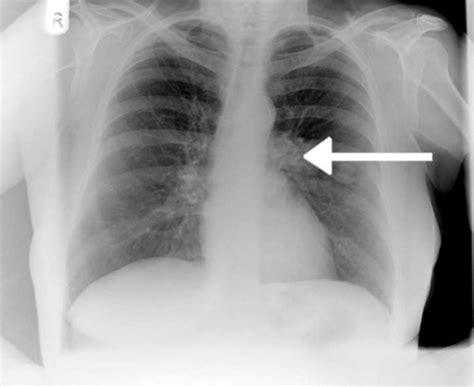 Chest Radiograph Showing Left Hilar Abnormality Arrow Open I