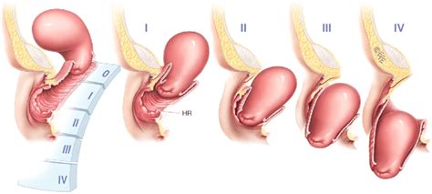 Shows Prolapse Staging 4 0 I Ii Iii Iv Uterine By