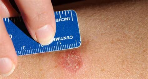 healthy skin tip heres   prevent  ringworm