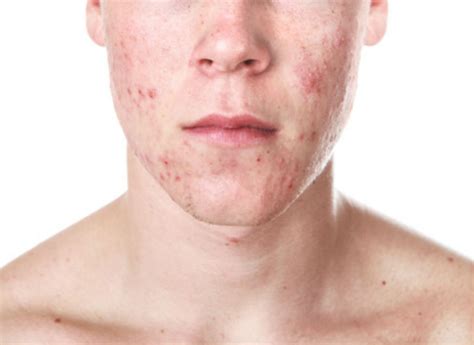 expert tips   rid  acne faster curehackscom
