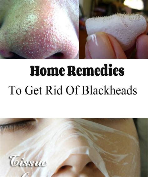 home remedies to get rid of blackheads tips webs