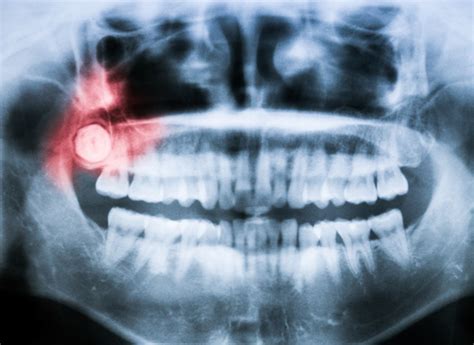 warning signs of impacted wisdom teeth mga dental emergency after