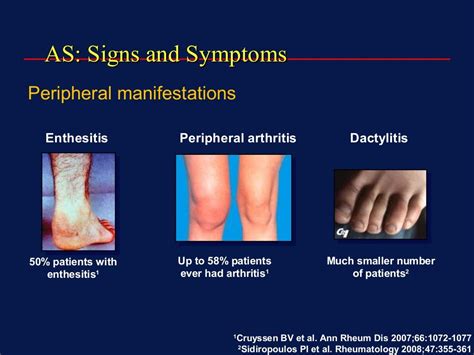 inflammatory arthritis  overview