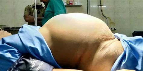 graphic image warning doctors find 26 pound tumor inside pregnant