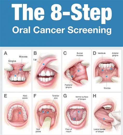 oral cancer screenings exton family dentist