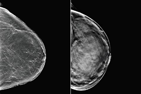 algorithm analyzes mammograms signals need for more breast cancer